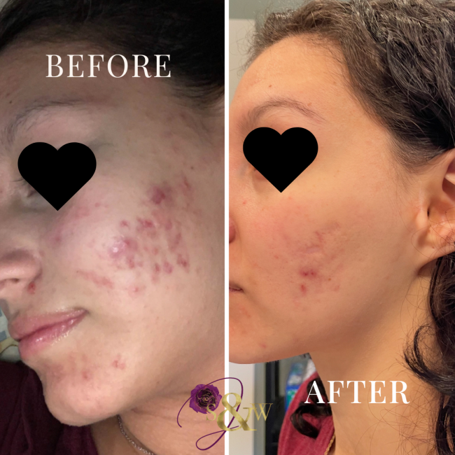 Before and After Acne Treatment