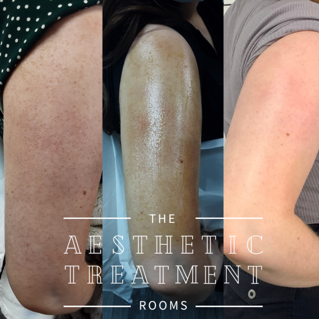 This image shows improvement of keratosis Pilaris using a chemical peel with microneedling