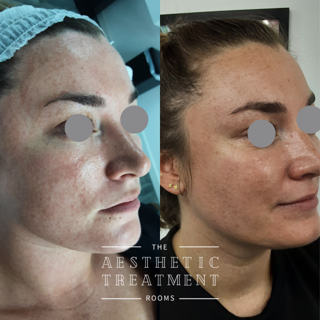 This image shows how BioRePeel can make skin appear brighter and improve texture