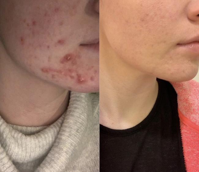 Before and After Acne Treatment