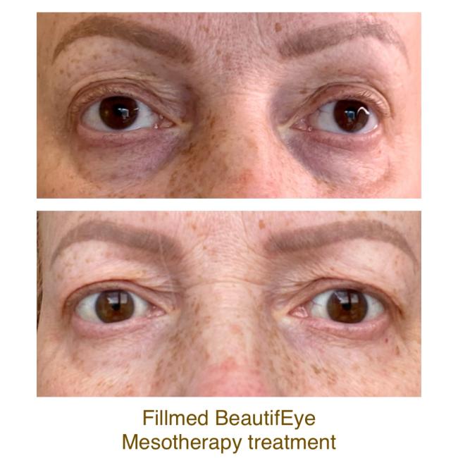 Fillmed BeautyfEye Mesotherapy eye treatment before and after