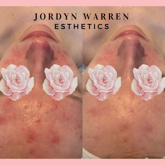 Before and After Acne Rosacea Treatment
