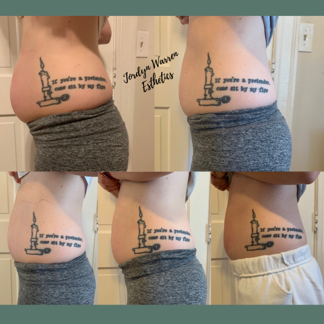 Before and After 10 Body Contour Sessions