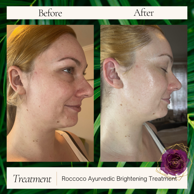 Before and After Brightening Treatment