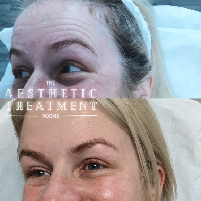 Improvement of the appearance of lines and wrinkles of crowns feet