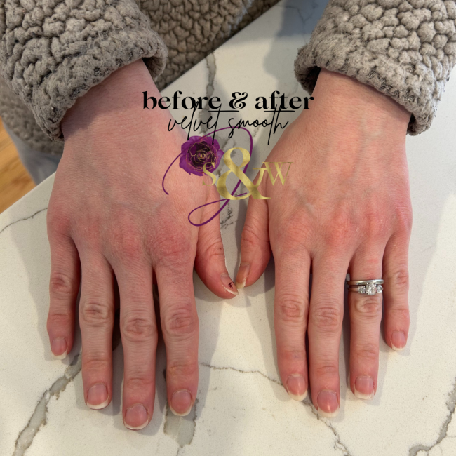 Before and After Anti-Aging Treatment