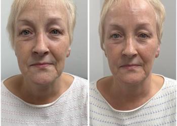 Skin Tightening Treatment, using radio frequency and Dermalux LED Light Therapyy