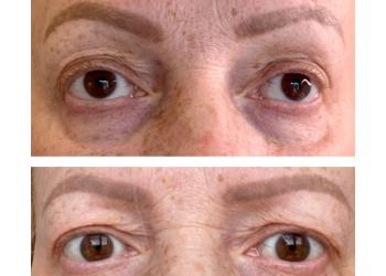 Fillmed BeautyfEye Mesotherapy eye treatment before and after