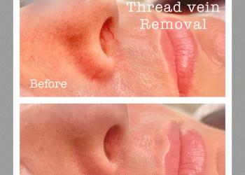 Thread vein treatment before and after
