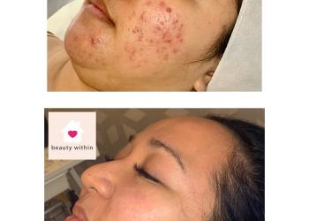 Skin peel results for acne skin