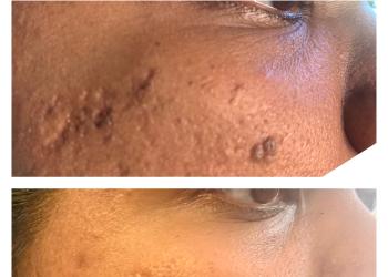 Advanced electrolysis treatment results for Dermatosis Papulosa Nigra