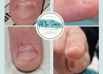 Verruca treatment