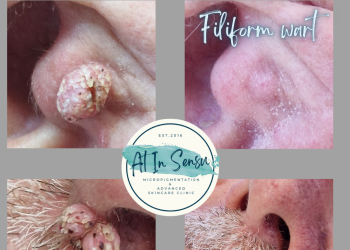 Wart removal treatment