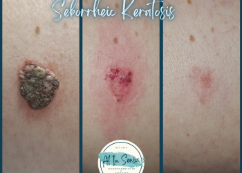 sebhoreic keratosis removal treatment