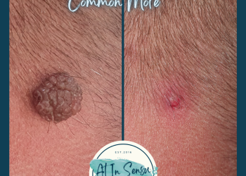 Mole removal